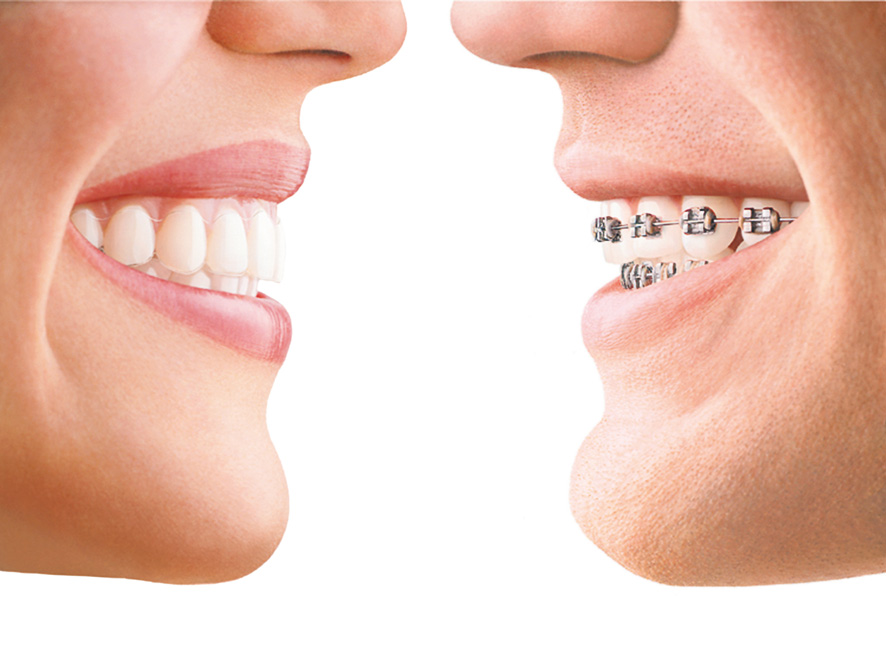 2016 Invisalign Off 080 Coated V2 Jpg Format Colour (32)